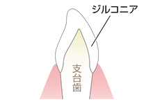 フルジルコニア