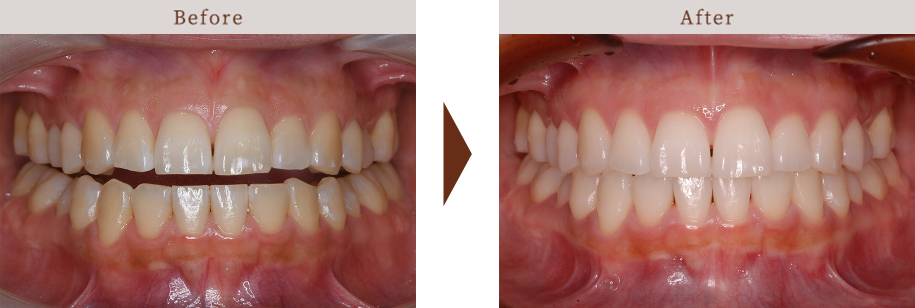 ホワイトニング術前後
