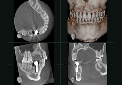 歯科用CT