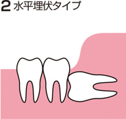 埋没タイプ
