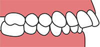 上の前歯や上顎が前に出ている