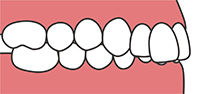 上の前歯が下の前歯に深く被さっている
