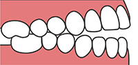 上下の歯の間に隙間がある