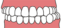 上下の奥歯が横にずれている