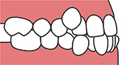 歯並びが凸凹している