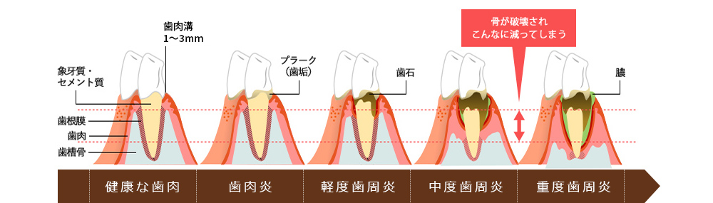 歯周病進行度