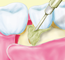 歯周組織再生療法